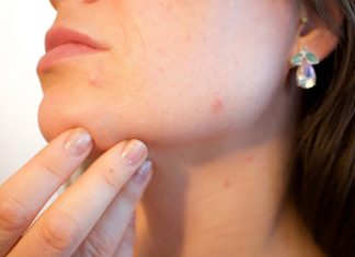 How-to-pop-a-pimple