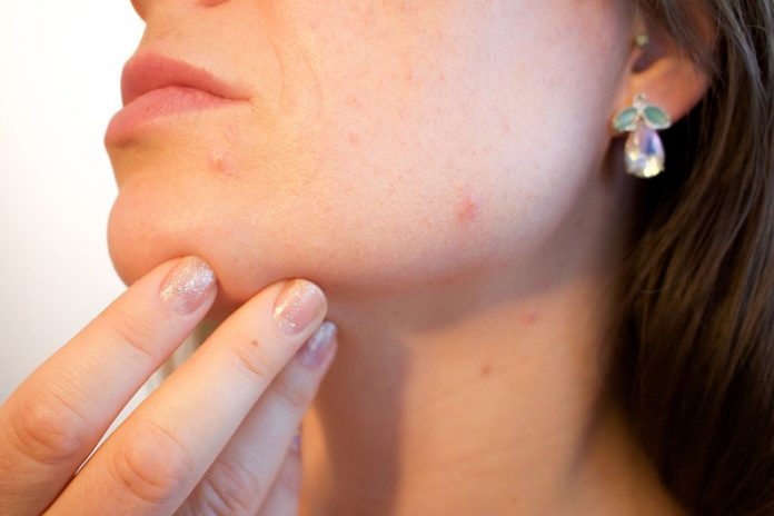 How-to-pop-a-pimple
